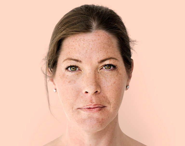 Skin pigmentation SF Med Aesthetics